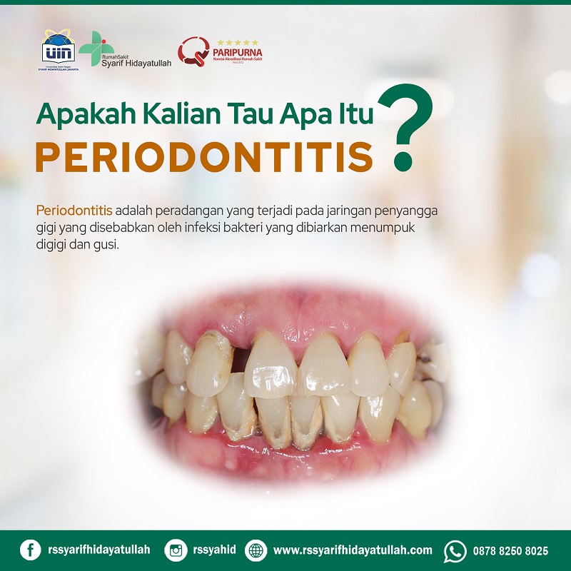 PERIODONTITIS slide 1
